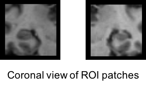 Coronal view of ROI patches